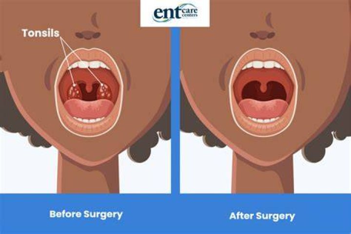 Was i born without tonsils?