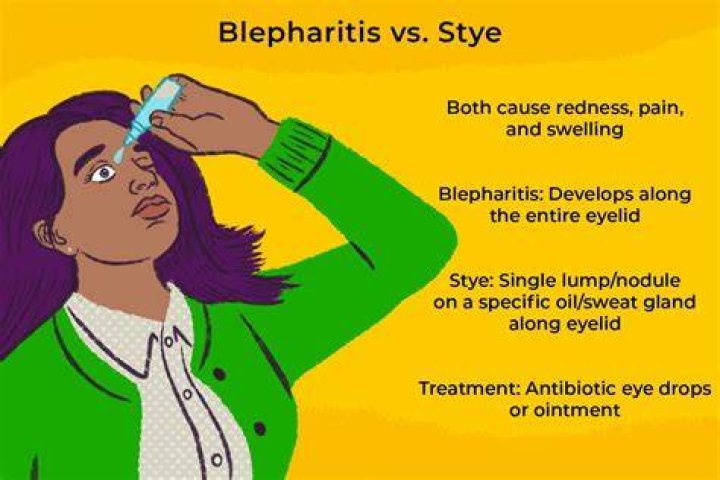 What causes recurring styes?